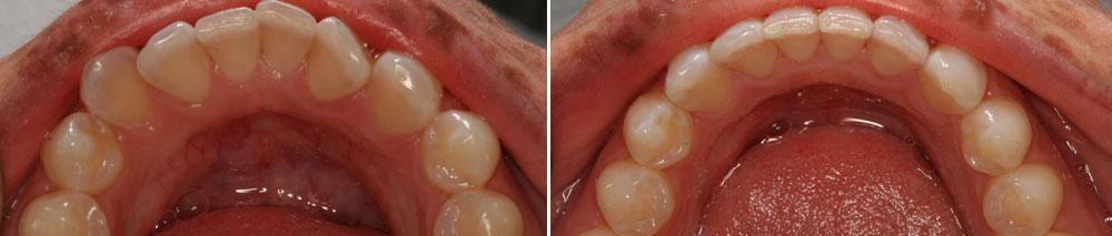 patient with straight teeth from Invisalign