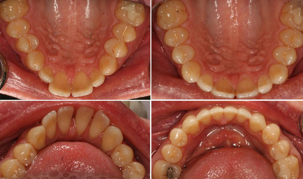 before and after pictures of Invisalign treatment