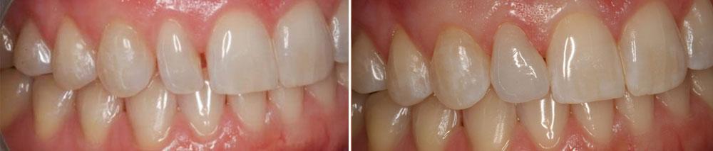 Invisalign and veneer treatment in Beverly Hills